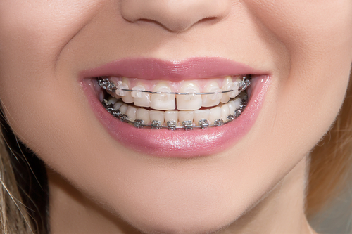 Orthodontic Coverage